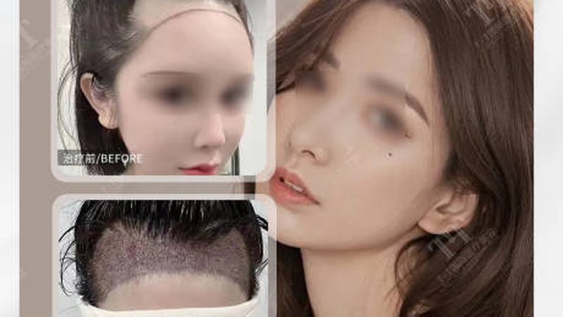 开内眼角与双眼皮：对比前后，揭秘整形美学奥秘