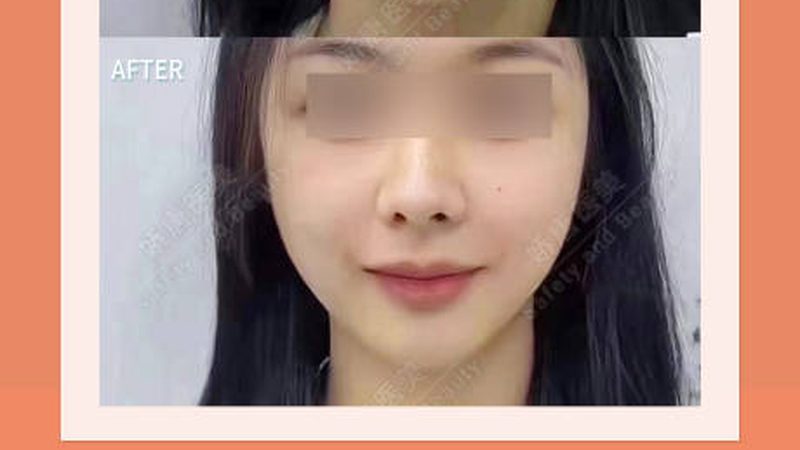 国产与进口瘦脸针：价格差异背后的真相