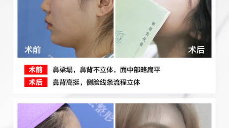 小标题：术后恢复概述