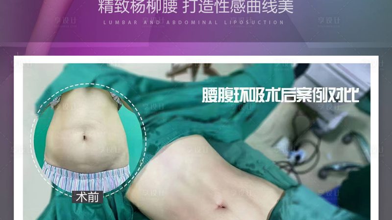隆鼻假体批发报价：揭秘市场真相与选型逻辑