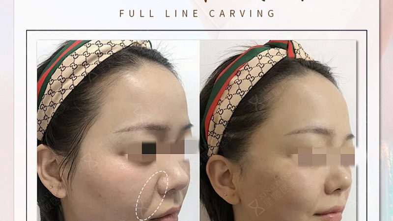 光子嫩肤与强脉冲光：揭秘价格背后的真相