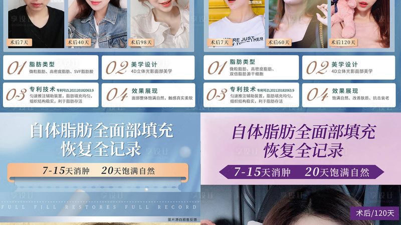隆鼻修复术后，这几点注意事项你一定要知道**