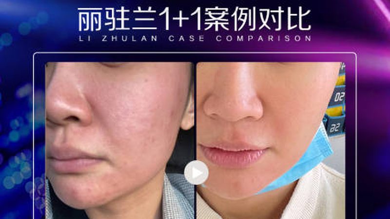 小标题：面部提升手术，常见误区盘点