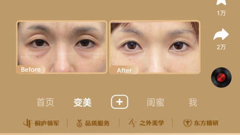 成都割双眼皮，价格背后的考量因素