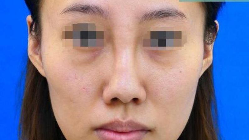 小标题：埋线提升与其他面部年轻化技术的对比
